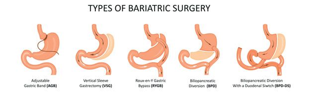 Bariatric Surgery Types